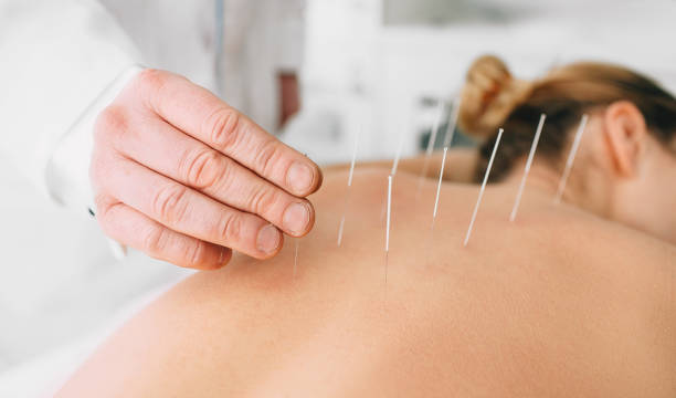 Acupuncture in St. Joseph - Exponential Chiropractic Healing Center